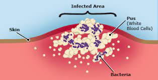 Infected Wounds | Urgent Wound Care | Wound Doctor Near Me