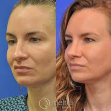 Exactly 1 year after open rhinoplasty, septoplasty and valve repair,  today's featured patient is thrilled by how natural and balanced her nose  looks! I lifted and refined her droopy tip while also