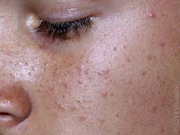 Image result for acne face
