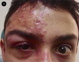 Image result for herpes zoster