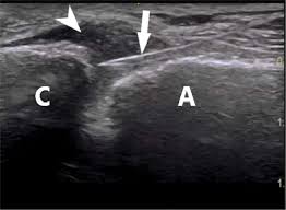 Image result for Shoulder Imaging