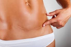 Cesarea 10 Cuidados Para Recuperar Mais Rapido Cesariana Abdominoplastia Recuperacao Cesariana