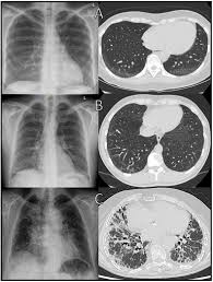Image result for XRay Changes in Rheumatic Conditions
