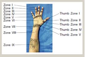 Image result for Elson Extensor Tendon Test