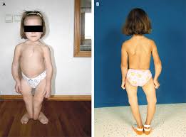 Image result for Rickets