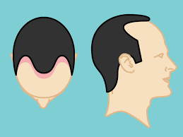 Whether stress speeds up the process of hereditary baldness is unknown. Male Pattern Baldness Causes Identification And Prevention