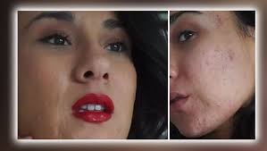 Maju su u školi maltretirali i nazivali prljavom zbog akni: Mnogi mogu da  se poistovete sa njom