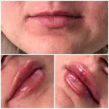 Best thing that i've ever done! Illume Aesthetics 993 Siskiyou Blvd Ste 1 Ashland Or Medical Spas Mapquest
