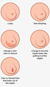What's new in breast cancer research, survival rates for breast cancer. breastcancer.org: Open Signs And Symptoms Of Breast Cancers Transparent Png 1000x1461 Free Download On Nicepng