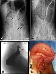 Image result for Sigmoid Volvulus