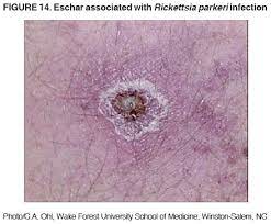 Diagnosis And Management Of Tickborne Rickettsial Diseases Rocky Mountain Spotted Fever Ehrlichioses And Anaplasmosis United States P P A Practical Guide For Physicians And Other Health Care And Public Health Professionals