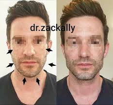Pin By Phil On Esthetic Procedures Cheek Implants Plastic Surgery Jawline
