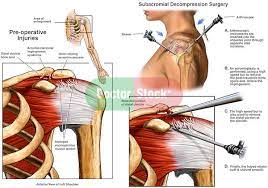 Nerve Impingement Shoulder Left Shoulder Impingement Syndrome Wih Arthroscopic Surger Shoulder Impingement Impingement Syndrome Shoulder Impingement Syndrome