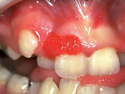 Image result for granuloma gum disease