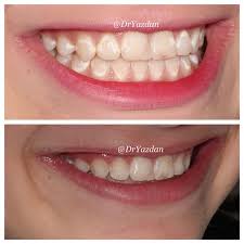 Image result for Tooth Discoloration