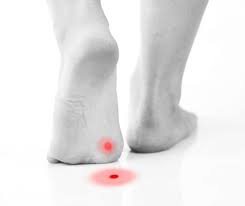Crush a vitamin c tablet and mix it with some water to form a paste. 5 Of The Best Verruca Treatments Northwich Foot Clinic