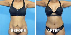 Mommy makeovers average about $10,000 to $30,000, a cost that can vary greatly from patient to patient. Best Mommy Makeover Houston Texas Surgical Arts