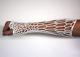 9 Ways 3 D Printing Makes The World Better Bone Fracture It Cast 3d Printing