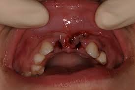 Image result for Tooth Avulsion