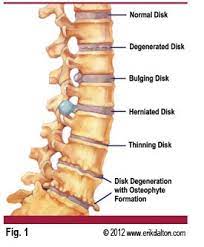 Oleh jara agustus 08, 2021 posting komentar a thoracic bulging disc is the least often seen type of intervertebral protrusion, since the middle and upper back spinal regions are far less likely to develop herniated discs. Herniated Discs And Bulging Discs Boulder Therapeutics