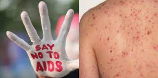 Gejala tanda & penularan hiv harus dihindari | clarin hayes. Tanda Tanda Hiv 15 Tanda Tak Disedari Ramai Orang Theasianparent Malaysia