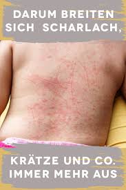 Die Plagen Sind Zuruck Kratze Windpocken Kinderkrankheiten
