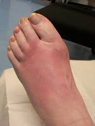 Oct 01, 2015 · charcot foot is a progressive, degenerative condition that affects the joints in the feet and is most commonly associated with vascular complications and nerve damage (neuropathy). Acute Charcot Foot The Bmj