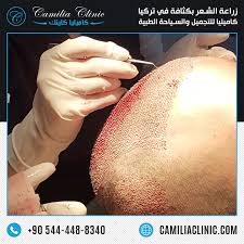 Hair Transplant Procedure In Turkey Using Perkutan Technique Hair Transplant Procedure Hair Transplant Hair