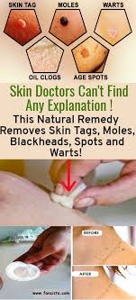 Skin Doctors Can T Find Any Explanation This Natural Remedy Removes Skin Tags Moles Blackheads Spots And Warts Fancista Com Skin Tag Removal Skin Tags Home Remedies Skin Tag