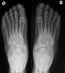 Maybe you would like to learn more about one of these? Mueller Weiss Syndrome Radiology Reference Article Radiopaedia Org
