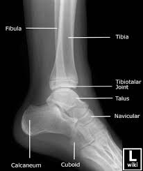 Image result for Ankle XRay