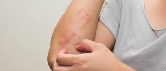 Image result for dermatitis contacta