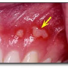 Herpetic gingivostomatitis is often the initial presentation during the first (primary) herpes simplex infection. Pdf Differential Diagnosis Is It Herpes Or Aphthous