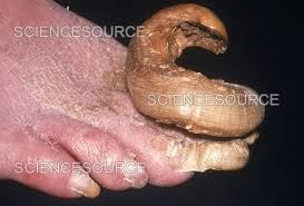 Image result for Onychogryphosis feet