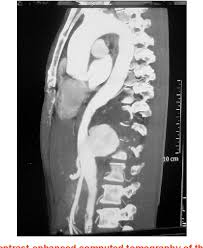 Image result for Cardiovascular Syphilis