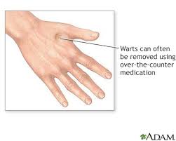 Compound w wart removal should be applied directly to the affected area (each wart should be the wart removal gel is developed to eliminate verrucas, warts, corns, and even calluses. Warts Information Mount Sinai New York