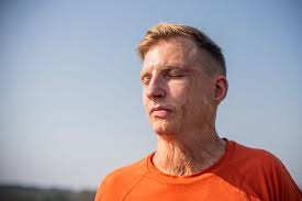 Hvert år samles mennesker med brannskader på Burn Camp: