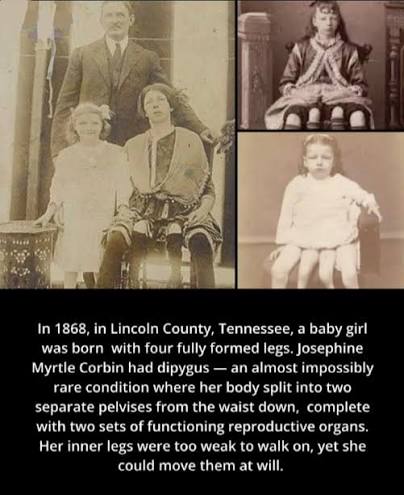 She was born with four legs — and went on to have five children. Josephine  Myrtle Corbin was born in 1868 in Lincoln County, Tennessee, with dipygus —  a rare congenital condition