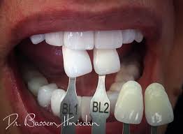 Dr Bassem Hmiedan On Instagram What Color Would You Choose أي لون تختارون مساء الخير Goodafternoon Teeth White Co Cosmetic Dentistry Dental Dentistry