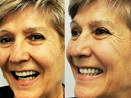 Depistare cancer oral Turda