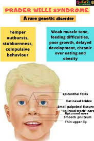 Psychomotor/developmental delay, seizures, and mild facial dysmorphism (including round face, frontal bossing, antimongoloid slant of the eyes, epicanthal folds. Pin On Blog
