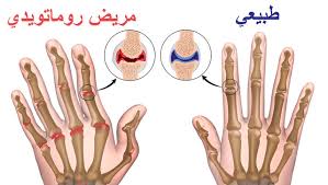 الصيدلية المنزلية علاج التهاب المفاصل الروماتويدي بالاعشاب كلام نسوان