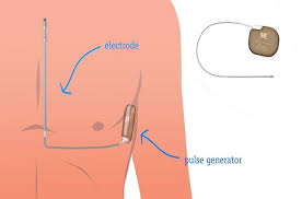 Il centrocampista danese aveva subito un arresto cardiaco contro la finlandia. Defibrillatore Sottocutaneo Contro La Morte Improvvisa