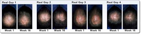 Your baby may be shedding the fine hair she was born with and known as laguna hair. Amazon Com Men S Rogaine Extra Strength 5 Minoxidil Topical Solution For Hair Loss And Hair Regrowth Topical Treatment For Thinning Hair 3 Month Supply Beauty