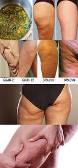 Calcio E Oil Antes E Depois Celulites Acabe Com Elas Em 3 Dias Curti Essa Receita Celulite Celulite Antes E Depois Tratamento Para Celulite