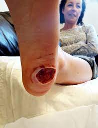 Mom left with gaping hole in foot after suspected wart revealed to be  cancer | Fox News