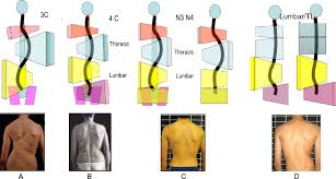 Physiotherapy Scoliosis Specific Exercises A Comprehensive Review Of Seven Major Schools Scoliosis And Spinal D Scoliosis Scoliosis Exercises Physiotherapy