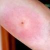 I felt a little bite during the night and then a sore quickly developed on my leg. Https Encrypted Tbn0 Gstatic Com Images Q Tbn And9gcrydfia2rgcg E3rmi21zxknswrroa Dwcw Pa0omgivjtujqdy Usqp Cau