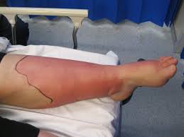 Sepsis is a medical emergency. Cellulitis Treatment Types And Symptoms