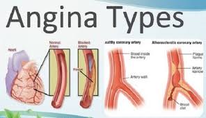 Angina atau angin duduk adalah nyeri dada yang muncul akibat adanya gangguan aliran darah ke jaringan otot jantung. Pertolongan Pertama Pada Gejala Angin Duduk